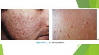 Verrugas (planas, acuminadas, plantares, vulgares) | PPTX
