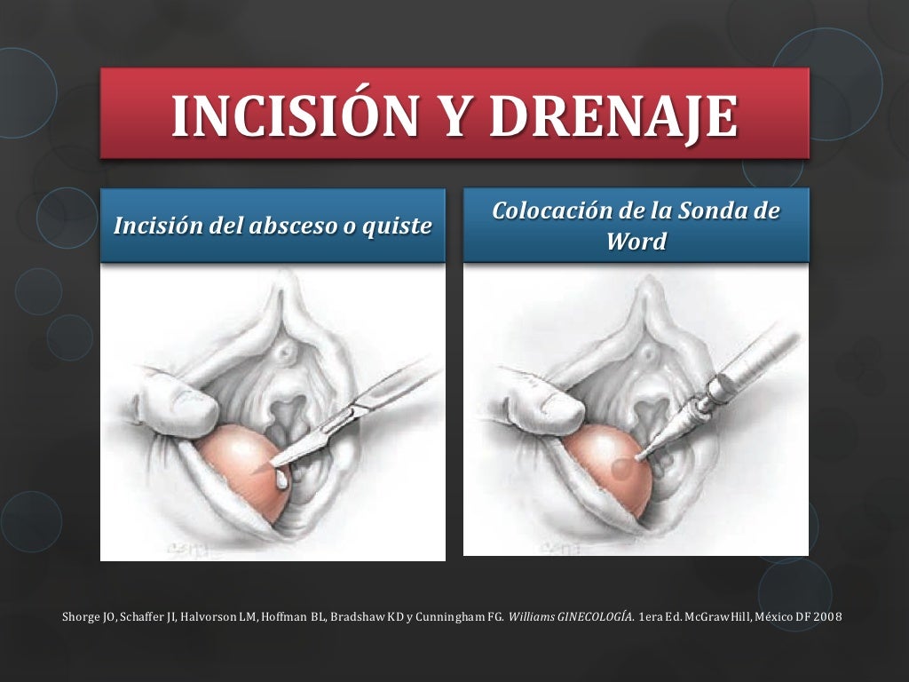 Porque Es Malo Soplar Los Genitales Verrugas genitales y enfermedad de la glándula de Bartolino