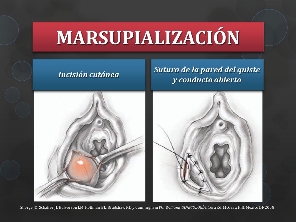Marsupialização Da Glandula De Bartholin Recuperação
