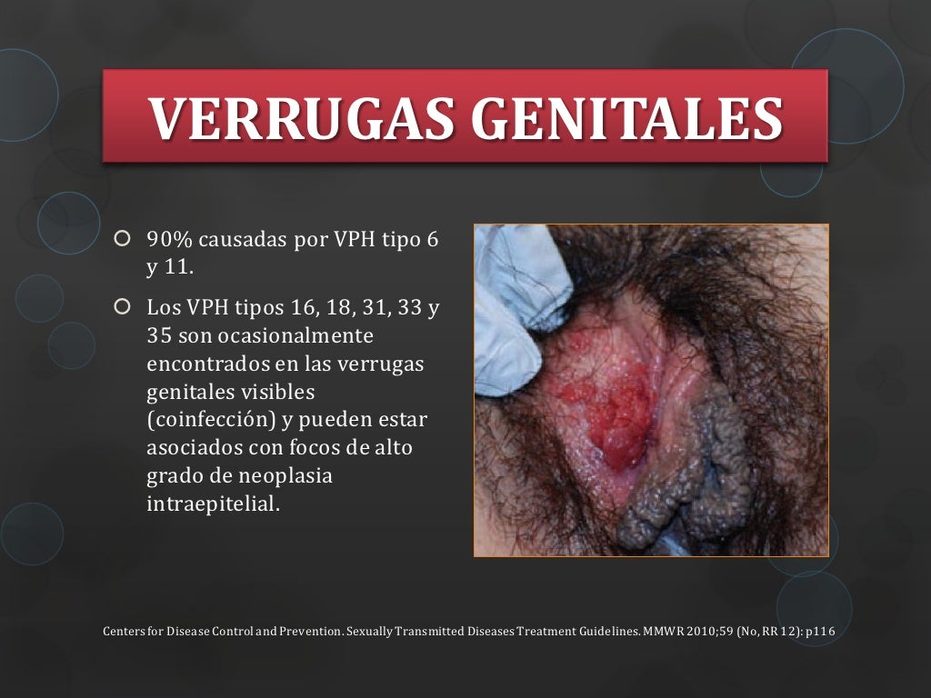 Marsupialização Da Glandula De Bartholin Recuperação