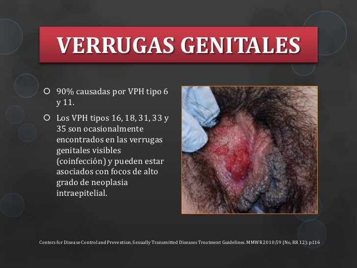 Porque Es Malo Soplar Los Genitales Verrugas genitales y enfermedad de la glándula de Bartolino