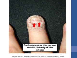 Cuando se presentan en el borde de la una
ocasionan distrofia ungueal y son
dolorosas
Roberto Arenas Guzman. (2013). Verrugas virales. En DERMATOLOGÍA, ATLAS, DIAGNÓSTICO Y TRATAMIENTO(937). Mexico D.F.: McGraw Hill.
 