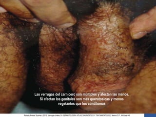 Las verrugas del carnicero son múltiples y afectan las manos.
Si afectan los genitales son mas queratosicas y menos
vegetantes que los condilomas
Roberto Arenas Guzman. (2013). Verrugas virales. En DERMATOLOGÍA, ATLAS, DIAGNÓSTICO Y TRATAMIENTO(937). Mexico D.F.: McGraw Hill.
 