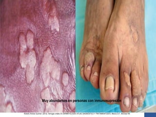 Muy abundantes en personas con inmunosupresión
Roberto Arenas Guzman. (2013). Verrugas virales. En DERMATOLOGÍA, ATLAS, DIAGNÓSTICO Y TRATAMIENTO(937). Mexico D.F.: McGraw Hill.
 