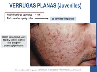 VERRUGAS PLANAS (Juveniles)
Neoformaciones pequeñas (1-4 mm)
Redondeadas o poligonales Se confunde con pápulas
Hacen cierto relieve sobre
la piel y son del color de
esta o un poco
eritematopigmentadas.
Roberto Arenas Guzman. (2013). Verrugas virales. En DERMATOLOGÍA, ATLAS, DIAGNÓSTICO Y TRATAMIENTO(937). Mexico D.F.: McGraw Hill.
 