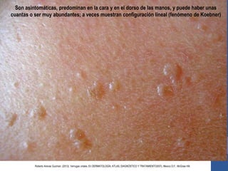 Son asintomáticas, predominan en la cara y en el dorso de las manos, y puede haber unas
cuantas o ser muy abundantes; a veces muestran configuración lineal (fenómeno de Koebner)
Roberto Arenas Guzman. (2013). Verrugas virales. En DERMATOLOGÍA, ATLAS, DIAGNÓSTICO Y TRATAMIENTO(937). Mexico D.F.: McGraw Hill.
 