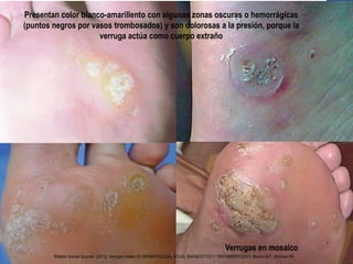 Verrugas en mosaico
Presentan color blanco-amarillento con algunas zonas oscuras o hemorrágicas
(puntos negros por vasos trombosados) y son dolorosas a la presión, porque la
verruga actúa como cuerpo extraño
Roberto Arenas Guzman. (2013). Verrugas virales. En DERMATOLOGÍA, ATLAS, DIAGNÓSTICO Y TRATAMIENTO(937). Mexico D.F.: McGraw Hill.
 