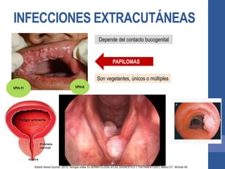 INFECCIONES EXTRACUTÁNEAS
Depende del contacto bucogenital
PAPILOMAS
VPH-6VPH-11
Son vegetantes, únicos o múltiples
Roberto Arenas Guzman. (2013). Verrugas virales. En DERMATOLOGÍA, ATLAS, DIAGNÓSTICO Y TRATAMIENTO(937). Mexico D.F.: McGraw Hill.
 