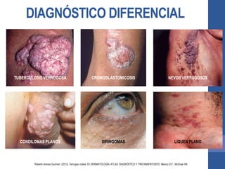 DIAGNÓSTICO DIFERENCIAL
TUBERCULOSIS VERRUGOSA CROMOBLASTOMICOSIS NEVOS VERRUGOSOS
CONDILOMAS PLANOS SIRINGOMAS LIQUEN PLANO
Roberto Arenas Guzman. (2013). Verrugas virales. En DERMATOLOGÍA, ATLAS, DIAGNÓSTICO Y TRATAMIENTO(937). Mexico D.F.: McGraw Hill.
 