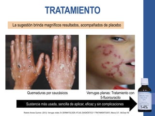 TRATAMIENTO
La sugestión brinda magníficos resultados, acompañados de placebo
Quemaduras por caucásicos Verrugas planas: Tratamiento con
5-fluorouracilo
Sustancia más usada, sencilla de aplicar, eficaz y sin complicaciones
1-4%
Roberto Arenas Guzman. (2013). Verrugas virales. En DERMATOLOGÍA, ATLAS, DIAGNÓSTICO Y TRATAMIENTO(937). Mexico D.F.: McGraw Hill.
 
