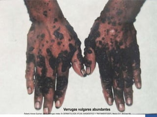 Verrugas vulgares abundantes
Roberto Arenas Guzman. (2013). Verrugas virales. En DERMATOLOGÍA, ATLAS, DIAGNÓSTICO Y TRATAMIENTO(937). Mexico D.F.: McGraw Hill.
 