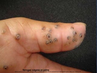 Verrugas vulgares en palma
Roberto Arenas Guzman. (2013). Verrugas virales. En DERMATOLOGÍA, ATLAS, DIAGNÓSTICO Y TRATAMIENTO(937). Mexico D.F.: McGraw Hill.
 
