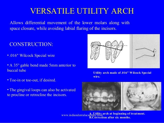 Versatile utility arch /certified fixed orthodontic courses by Indianโฆ