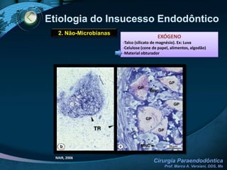 Etiologia do Insucesso Endodôntico1. Microbianasb. Infecção extra-radicularINCIDÊNCIA DE BIOFILME PERIRRADICULAR: 4%DIAGNÓSTICO CLÍNICO IMPOSSÍVELBIOFILME: População microbiana aderida a um substrato orgânico ou inorgânico, estando envolvida por seus produtos extracelulares, os quais forma uma matriz intermicrobiana, apresentando maior resistência a agentes antimicrobianos e aos mecanismos de defesa do hospedeiro, encontrando-se fora do campo de atuação dos procedimentos endodônticosintracanas.NAIR, 2006ARAKI et al. 2006