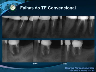 Etiologia do Insucesso Endodôntico2. Não-MicrobianasEXÓGENOTalco (silicato de magnésio). Ex: Luva