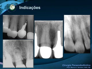 Material obturadorNAIR, 2006
