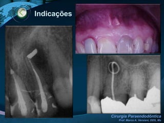 Etiologia do Insucesso Endodôntico2. Não-MicrobianasEXÓGENOTalco (silicato de magnésio). Ex: Luva