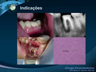 Material obturadorNAIR, 2006