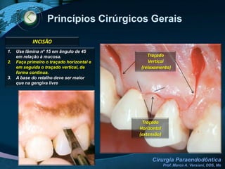 AnestesiaINCISIVO A CANINO SUPERIORTERMINAL INFILTRATIVABLOQUEIO REGIONALa) Forame Infra-Orbitário (NAS anterior e médio)b) Forame Incisivo