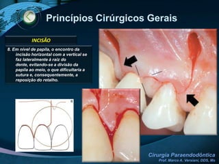 AnestesiaMOLARES SUPERIORESTERMINAL INFILTRATIVA (palato)BLOQUEIO REGIONALa) Forame Infra-Orbitário (NAS anterior e médio)b) NAS posteriorc) Forame Palatino Maior (Nervo Palatino Posterior)