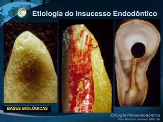 Fungos: Candidaalbicans, ActinomycesisraeliiINFECÇÃO SECUNDÁRIAM.O. extremamente resistentes a medicamentos e substâncias comumente empregados em Endodontia, como o hidróxido de cálcio.O fracasso atribuído a m.o que permaneceram viáveis, somente advirá se estes tiverem acesso aos tecidos perirradiculares, se foram patogênicos e se estiverem em número suficiente para induzir ou perpetuar uma lesão perirradicular.PERCOLAÇÃO DE FLUIDOS TECIDUAIS RICOS EM GLICOPROTEÍNAS PARA O INTERIOR DO SCR  -> SUBSTRATO PARA M.O. RESIDUAIS -> PROLIFERAÇÃO .SELAMENTO MARGINAL  (APICAL,  LATERAL E CERVICAL)