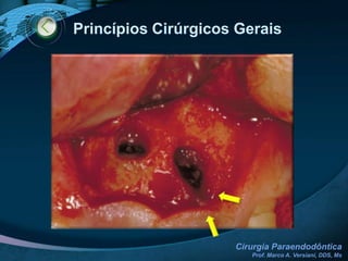 Assepsia CirúrgicaCOLOCAÇÃO DOS CAMPOS CIRÚRGICOS ESTERILIZADOS
