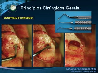 Princípios Cirúrgicos Gerais INCISÃOUse lâmina nº 15 em ângulo de 45° em relação à mucosa.Faça primeiro o traçado horizontal e em seguida o traçado vertical, de forma contínua.A base do retalho deve ser maior que na gengiva livreTraçado Vertical (relaxamento)TraçadoHorizontal (extensão)