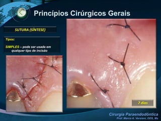 Princípios Cirúrgicos Gerais INCISÃO8. Em nível de papila, o encontro da incisão horizontal com a vertical se faz lateralmente à raiz do dente, evitando-se a divisão da papila ao meio, o que dificultaria a sutura e, consequentemente, a reposição do retalho.