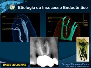 LIMITE DA OBTURAÇÃO (SOBREOBTURAÇÃO)