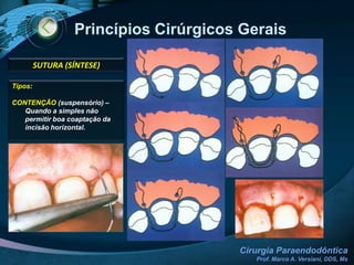 Princípios Cirúrgicos Gerais INCISÃOTipos:LinearTriangularTrapezoidalDefinição:Compõe-se de apenas uma incisão horizontalLocal:Região palatina de molares e pré-molares