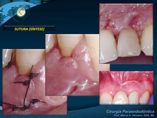 Princípios Cirúrgicos Gerais INCISÃOTipos:LinearTriangularTrapezoidalDefinição:Compõe-se de 1 incisão horizontal e 1 vertical, normalmente na mesial.Tipos:Portland (Wustrow): Incisão horizontal em nível de gengiva inserida.Neuman: Incisão horizontal em nível de papila.*