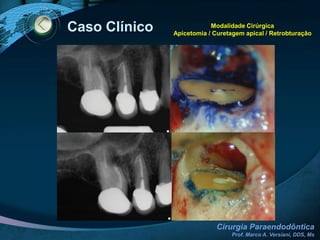 Complicações Trans-CirúrgicasAnestesia: técnica ou tipo de anestésico LipotimiaHemorragia (tecido de granulação / pequenos vasos)Comunicação buco-sinusalComplicações Pós-CirúrgicasEdema (afastador de Farabeuf)HematomaRuptura de pontos (fio muito fino, nó mal executado, apoio errado na mucosa)Deiscência (erro de sutura)Confecção do TCLEhttp://www.forp.usp.br/images/stories/etica/doc7.doc 