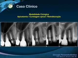 Complicações Trans-CirúrgicasCOMUNICAÇÃO SINUSALInforme ao paciente do ocorridoAvise-o da possibilidade de sangramento nasal ou sensação de gosto de sangueProceder sutura oclusiva ou superposição de membranaAdministrar descongestionante nasal (DescongexPlus, Naldecon, Fluviral - 3 a 4 inalações diárias ou quantas forem necessárias)Administrar antibióticoProceder sutura adequada da incisãoEvitar soar o nariz (tossir com a boca aberta)Não irrigar