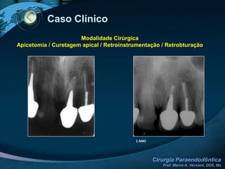 Complicações Pós-CirúrgicasPARESTESIA (LESÃO NAI / MENTONIANO)Informe ao paciente do ocorridoTranquilize-o quanto a volta ao normalNão estabeleça tempo para istoDetermine a extensão da área afetada com um instrumento e anote para futura comparaçãoControle periodicamente o pacienteRecomendar uso de compressas quentesMedicação (Citoneurin 5000 – 2 a 4 comprimidos diários durante 15 dias (Vitaminas B1, B6 e B12)Em alguns casos, recomende terapia com Laser de Baixa Potência