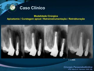 Modalidades CirúrgicasDrenagem cirúrgicaTrefinaçãoCuretagem periradicularApicoplastia/ApicetomiaCirurgia com obturação simultânea do canalObturação retrógradaRetroinstrumentação com retrobturação e obturação retrógradaCanalizaçãoCirurgia de cistos radicularesRizectomiaOdontosecçãoReimplante intencionalTransfixação endodôntica