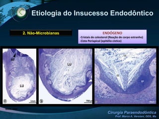 FRATURA DENTALEXTRUSÃO DE RASPAS DE DENTINA -> M.O. FISICAMENTE ISOLADOS DOS MECANISMOS DE DEFESA -> AGRESSÃO PERMANENTE1. MicrobianasInfecção intra-radicularLOPES & SIQUEIRA JR, 2004