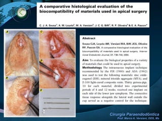 Caso ClínicoModalidade CirúrgicaApicetomia / Curetagem apical / Retrobturação