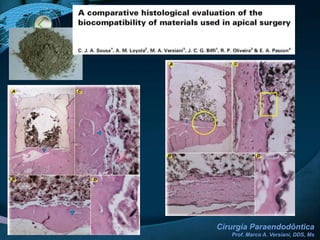 Caso ClínicoModalidade CirúrgicaApicetomia / Curetagem apical / Retrobturação2 ANOS