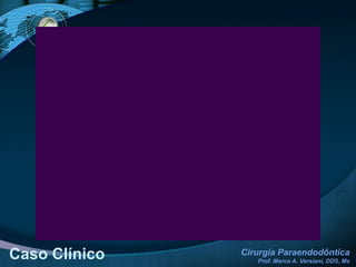 Caso ClínicoModalidade CirúrgicaApicetomia / Curetagem apical / Retroinstrumentação / Retrobturação2  ½ ANOS