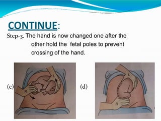 CONTINUE:
Step-3. The hand is now changed one after the
other hold the fetal poles to prevent
crossing of the hand.
(c) ( (d)
 