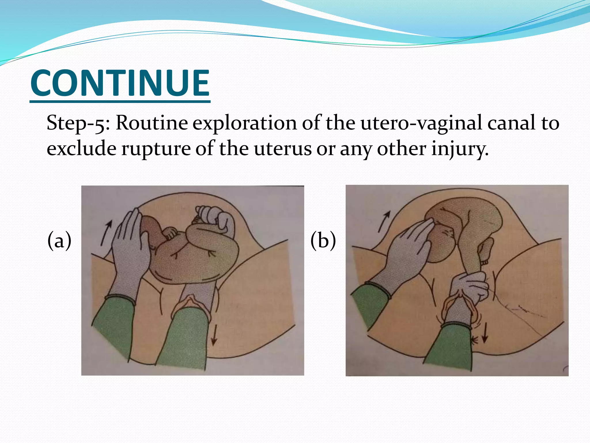 CONTINUE
Step-5: Routine exploration of the utero-vaginal canal to
exclude rupture of the uterus or any other injury.
(a) ( (b)
 