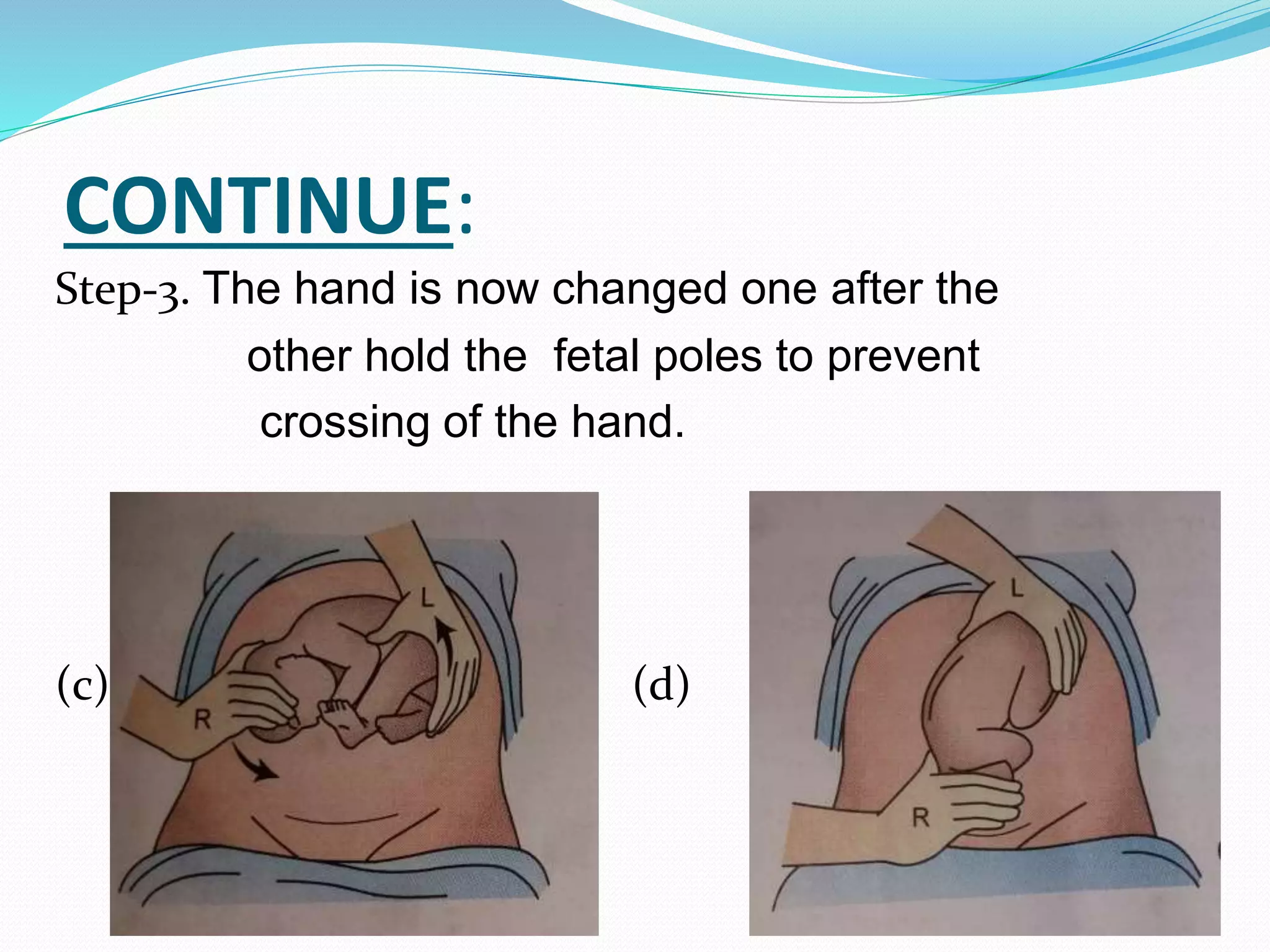 CONTINUE:
Step-3. The hand is now changed one after the
other hold the fetal poles to prevent
crossing of the hand.
(c) ( (d)
 