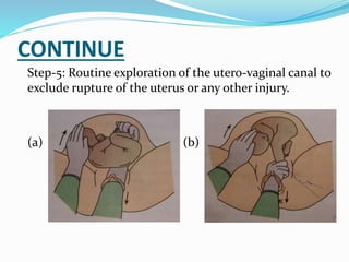CONTINUE
Step-5: Routine exploration of the utero-vaginal canal to
exclude rupture of the uterus or any other injury.
(a) ( (b)
 