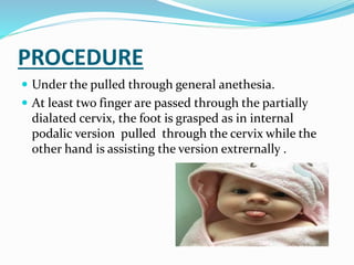 PROCEDURE
 Under the pulled through general anethesia.
 At least two finger are passed through the partially
dialated cervix, the foot is grasped as in internal
podalic version pulled through the cervix while the
other hand is assisting the version extrernally .
 