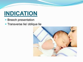 INDICATION
 Breech presentation
 Transverse lie/ oblique lie
 