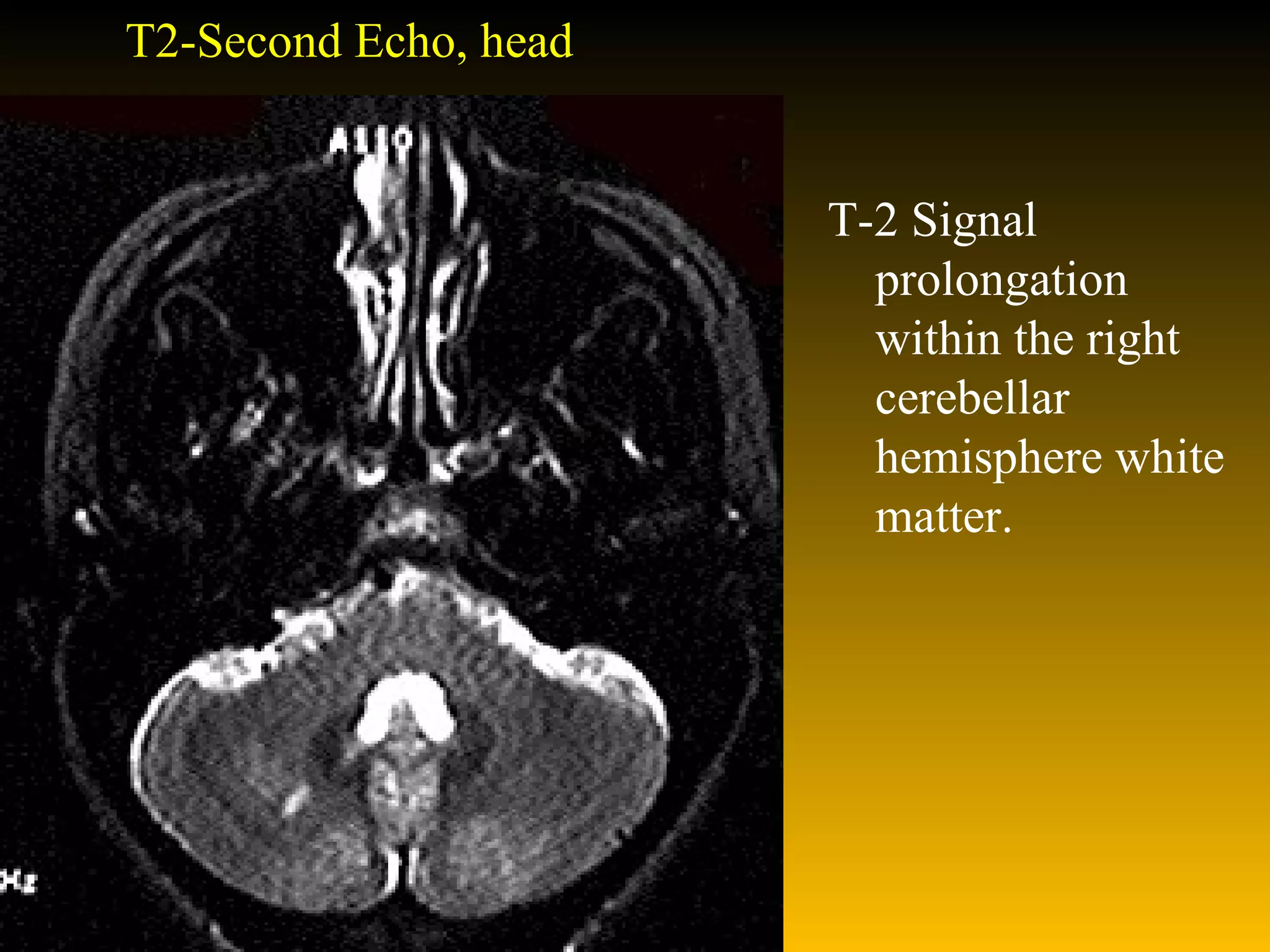 T2-Second Echo, head T-2 Signal prolongation within the right cerebellar hemisphere white matter. 