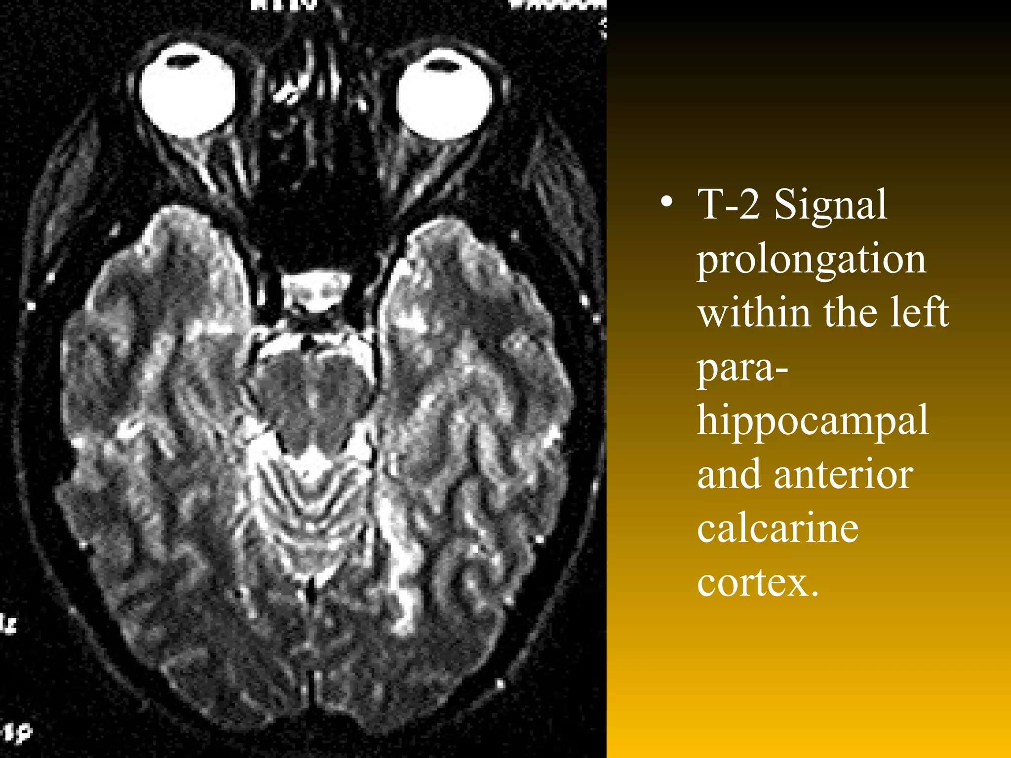 T-2 Signal prolongation within the left para-hippocampal and anterior calcarine cortex.  