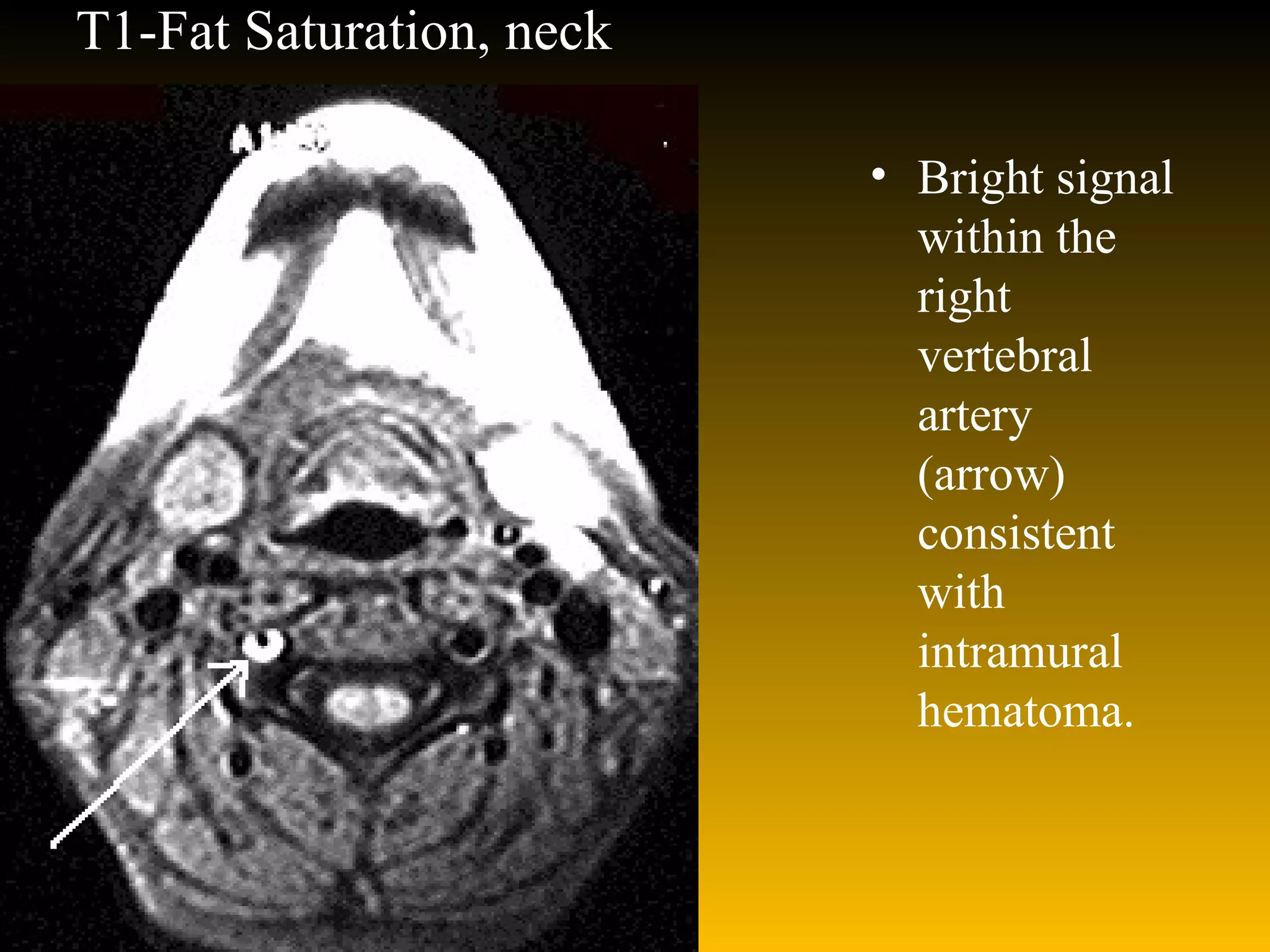 T1-Fat Saturation, neck Bright signal within the right vertebral artery (arrow) consistent with intramural hematoma. 