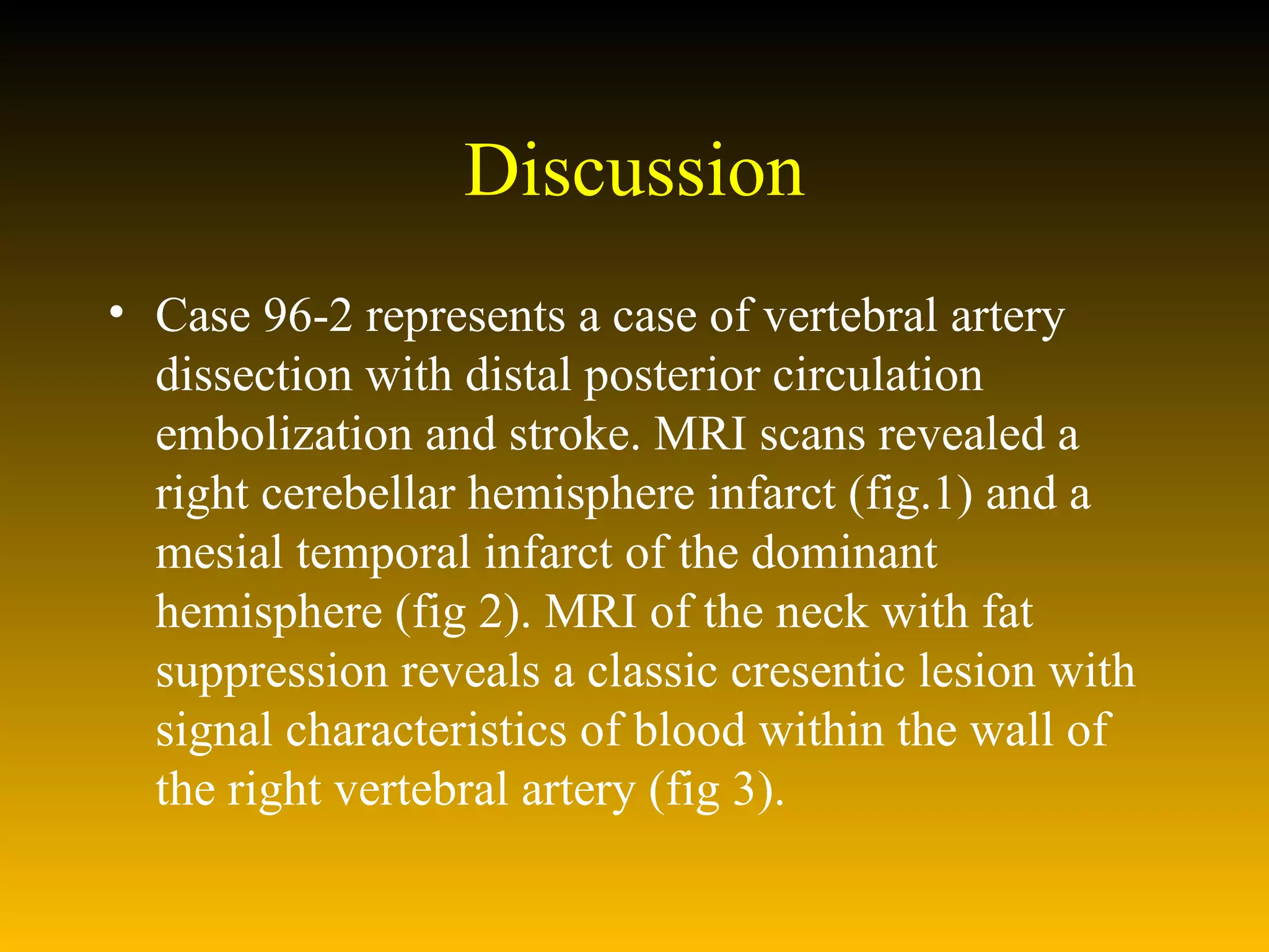 Discussion Case 96-2 represents a case of vertebral artery dissection with distal posterior circulation embolization and stroke. MRI scans revealed a right cerebellar hemisphere infarct (fig.1) and a mesial temporal infarct of the dominant hemisphere (fig 2). MRI of the neck with fat suppression reveals a classic cresentic lesion with signal characteristics of blood within the wall of the right vertebral artery (fig 3).  