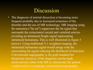 Discussion The diagnosis of arterial dissection is becoming more frequent probably due to increased awareness of the disorder and the use of MR technology. MR imaging using fat saturation ("fat sat") suppresses the fat signal that surrounds the extracranial carotid and vertebral arteries revealing an intramural bright signal representing intramural hematoma. This is well illustrated in figure 3 (arrow). Using traditional T-1 weighted imaging, the intramural hematoma signal would merge with the surrounding fat signal reducing the likelihood of detection. Conventional angiography is the gold standard for dissection; however, if the diagnosis can be made noninvasively either with MR or ultrasound, the patient would not have to undergo conventional angiography.  